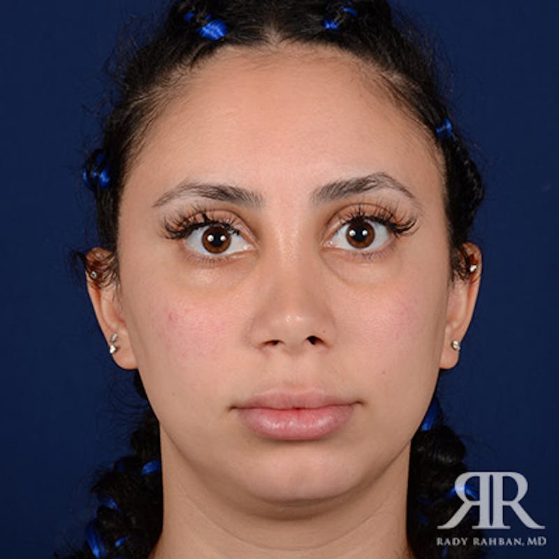 Chin Augmentation Before & After Gallery - Patient 233951 - Image 1