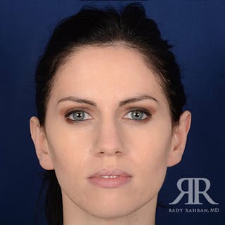 Ear Pinning Surgery Before & After Gallery - Patient 172540 - Image 2