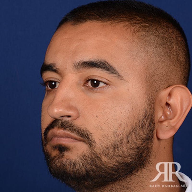 Male Rhinoplasty Before & After Gallery - Patient 361331 - Image 3