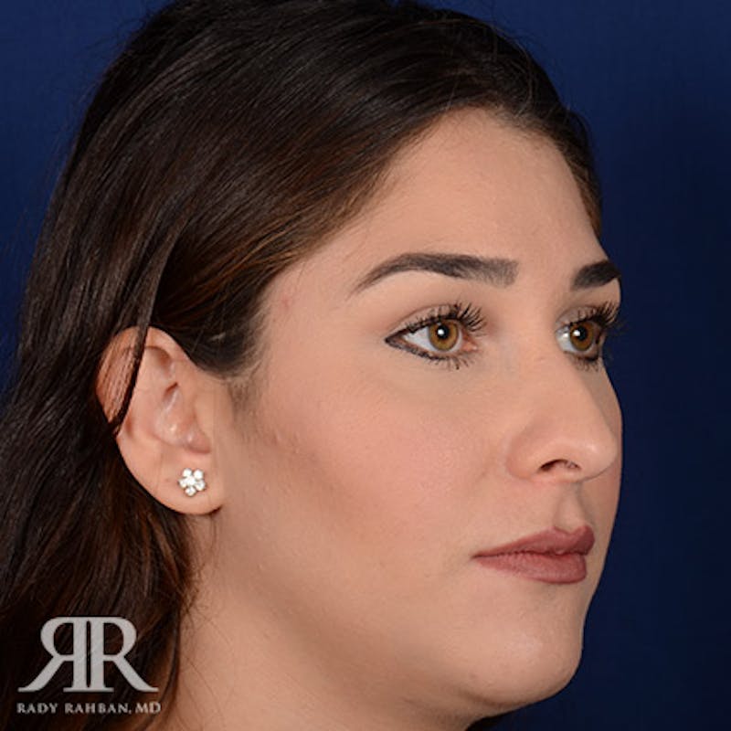 Female Rhinoplasty Before & After Gallery - Patient 129545 - Image 3