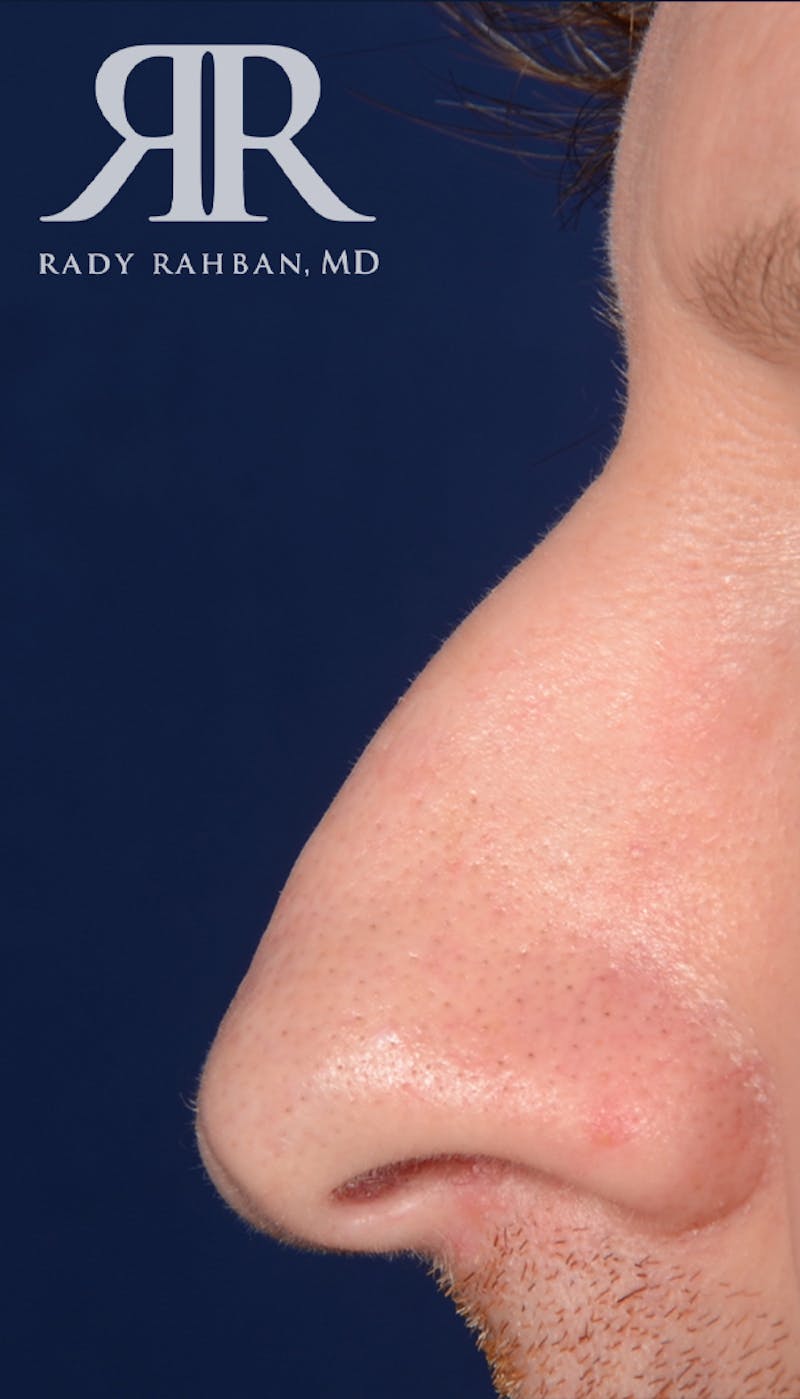Rhinoplasty Close Up Before & After Gallery - Patient 273777 - Image 1