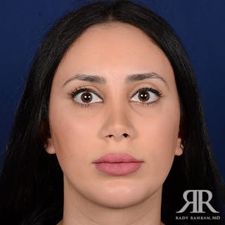 Chin Augmentation Before & After Gallery - Patient 233951 - Image 2