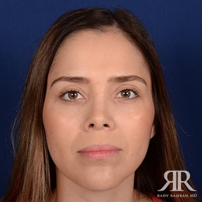 Corrective / Revision Rhinoplasty Before & After Gallery - Patient 285668 - Image 2