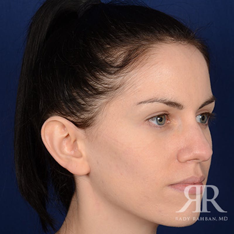 Ear Pinning Surgery Before & After Gallery - Patient 172540 - Image 3
