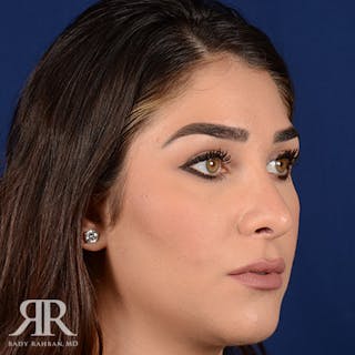 Female Rhinoplasty Before & After Gallery - Patient 129545 - Image 4