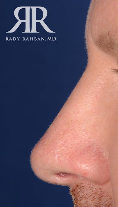 Rhinoplasty Close Up Before & After Gallery - Patient 273777 - Image 2