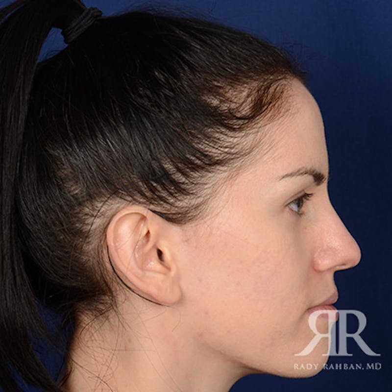 Ear Pinning Surgery Before & After Gallery - Patient 172540 - Image 5