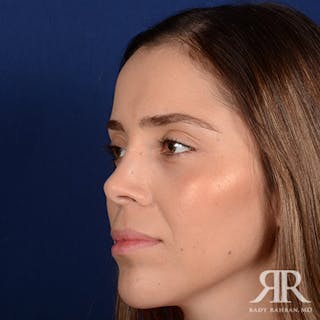 Corrective / Revision Rhinoplasty Before & After Gallery - Patient 285668 - Image 4