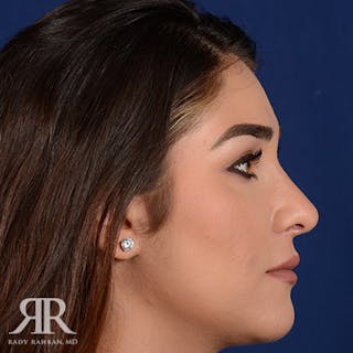 Female Rhinoplasty Before & After Gallery - Patient 129545 - Image 6