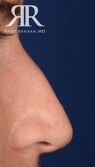 Rhinoplasty Close Up Before & After Gallery - Patient 193731 - Image 1