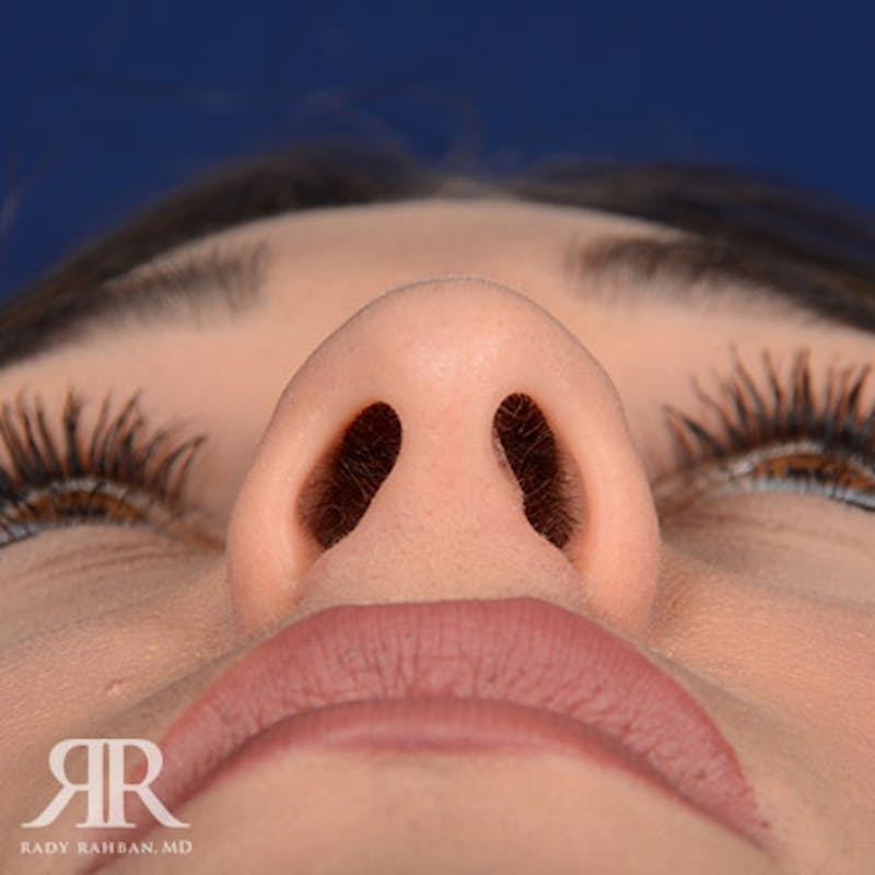 Female Rhinoplasty Before & After Gallery - Patient 129545 - Image 7