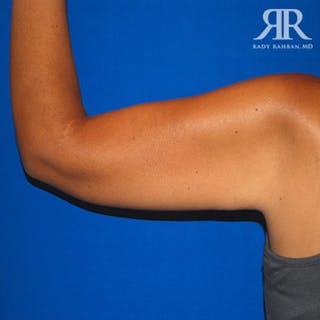 Arm Lift Before & After Gallery - Patient 352142 - Image 4