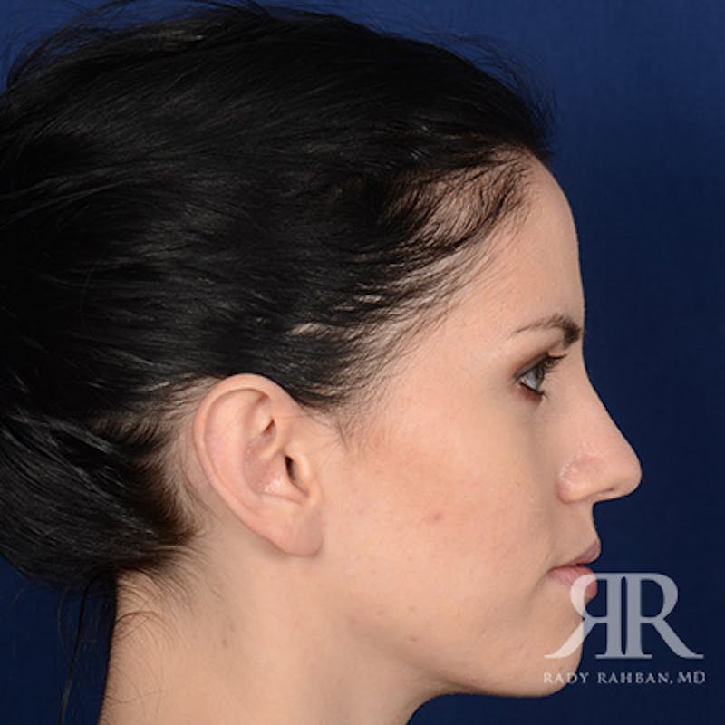 Ear Pinning Surgery Before & After Gallery - Patient 172540 - Image 6