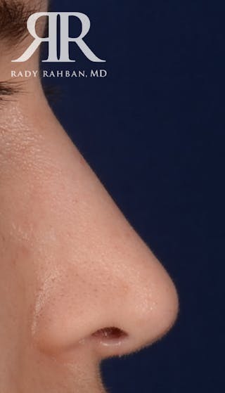 Rhinoplasty Close Up Before & After Gallery - Patient 193731 - Image 2