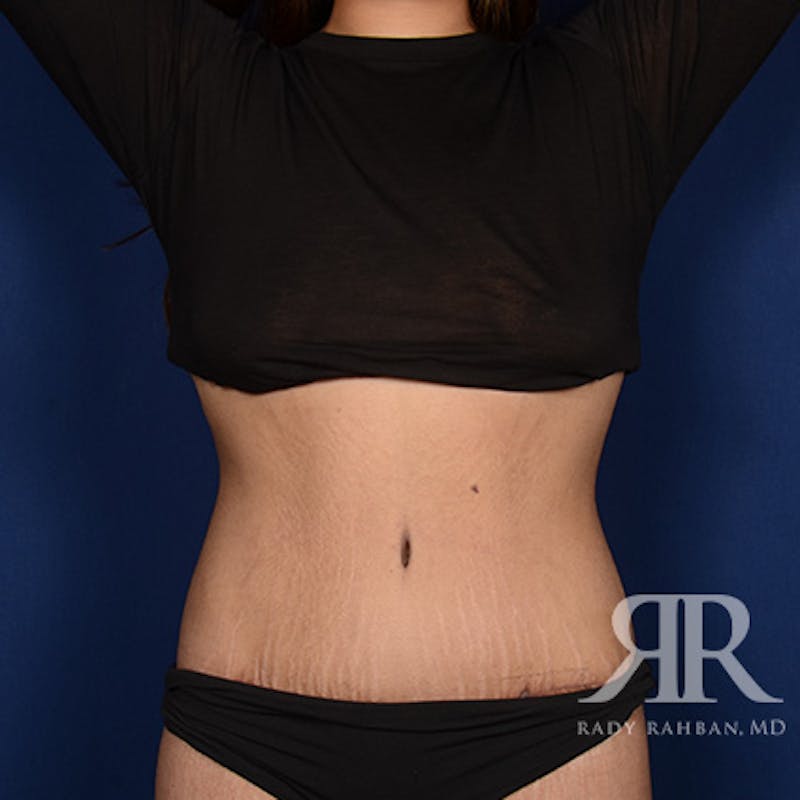Body Lift Before & After Gallery - Patient 425509 - Image 2