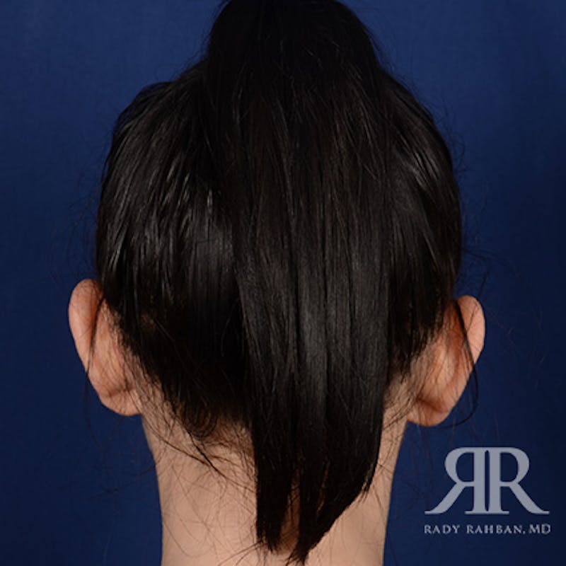 Ear Pinning Surgery Before & After Gallery - Patient 172540 - Image 7