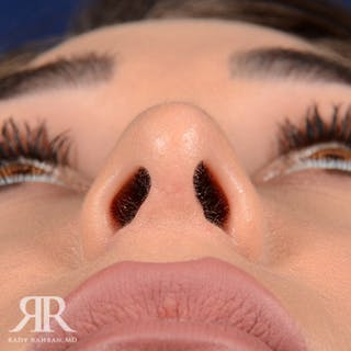 Female Rhinoplasty Before & After Gallery - Patient 129545 - Image 8