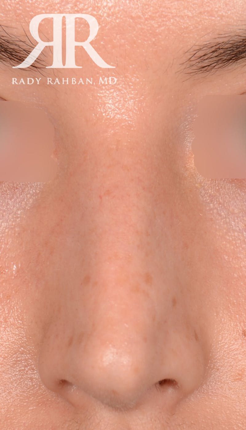 Rhinoplasty Close Up Before & After Gallery - Patient 193731 - Image 3