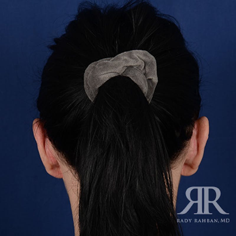 Ear Pinning Surgery Before & After Gallery - Patient 172540 - Image 8
