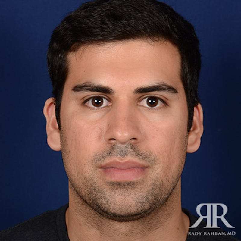 Chin Augmentation Before & After Gallery - Patient 717203 - Image 1