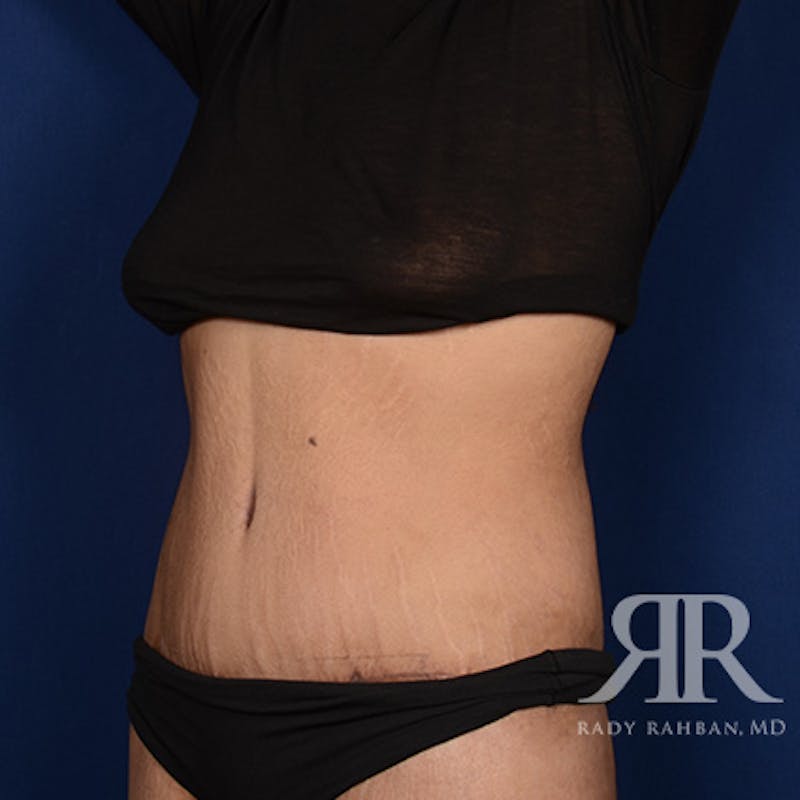 Body Lift Before & After Gallery - Patient 425509 - Image 4