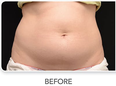 CoolSculpting Before & After Gallery - Patient 111318 - Image 1