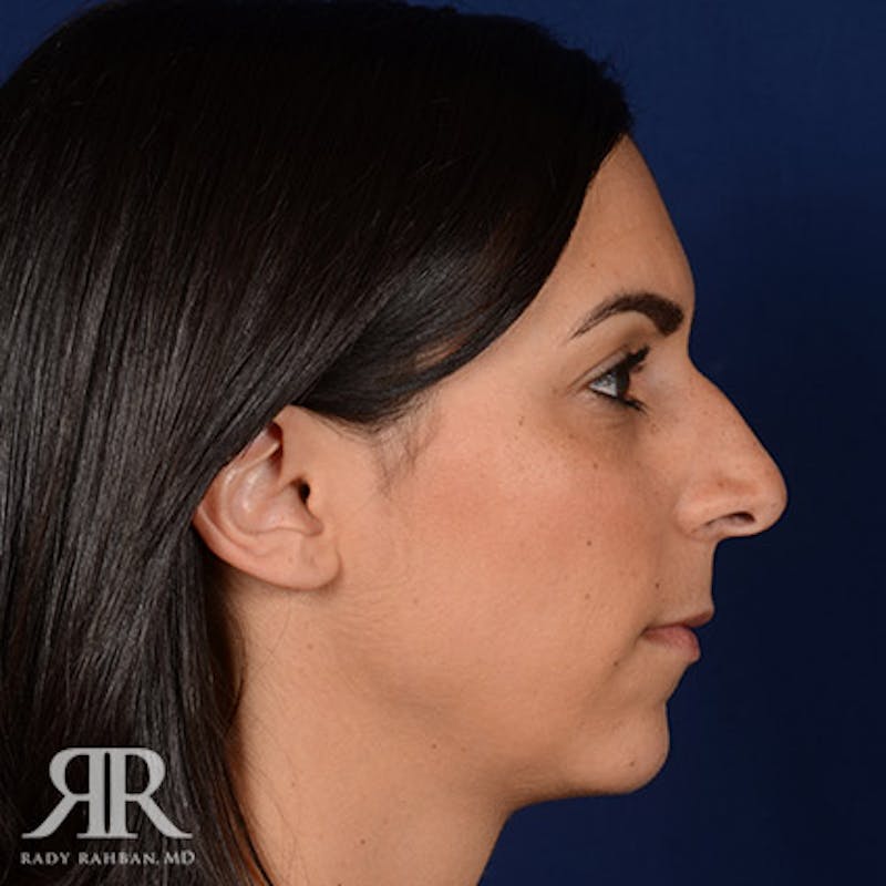 Rhinoplasty w/ Chin Implant Before & After Gallery - Patient 143598 - Image 5
