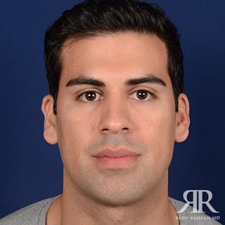 Chin Augmentation Before & After Gallery - Patient 717203 - Image 2