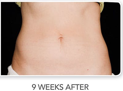CoolSculpting Before & After Gallery - Patient 111318 - Image 2