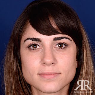 Female Rhinoplasty Before & After Gallery - Patient 122339 - Image 2