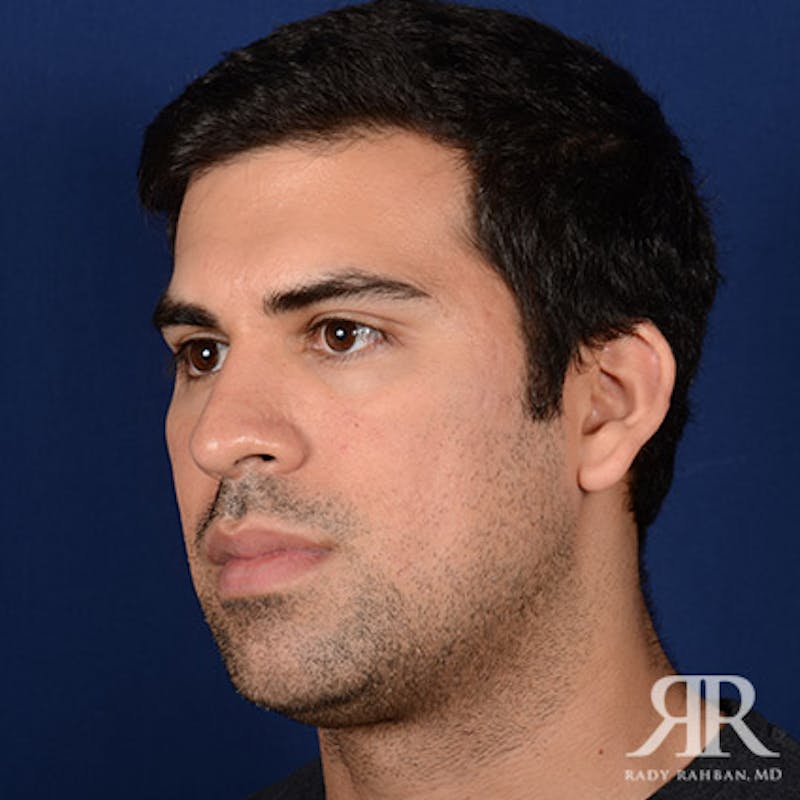 Chin Augmentation Before & After Gallery - Patient 717203 - Image 3