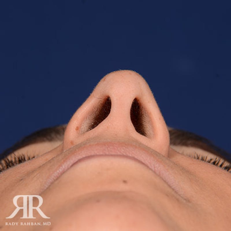 Rhinoplasty w/ Chin Implant Before & After Gallery - Patient 143598 - Image 7