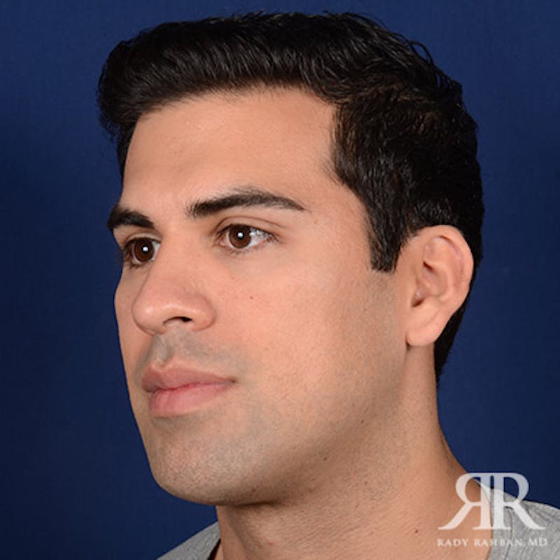 Chin Augmentation Before & After Gallery - Patient 717203 - Image 4