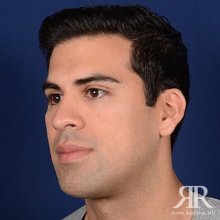 Chin Augmentation Before & After Gallery - Patient 717203 - Image 4
