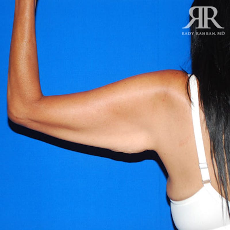 Arm Lift Before & After Gallery - Patient 661592 - Image 3