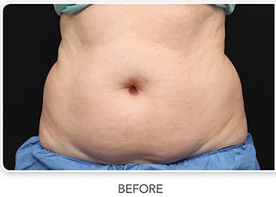 CoolSculpting Before & After Gallery - Patient 100981 - Image 1