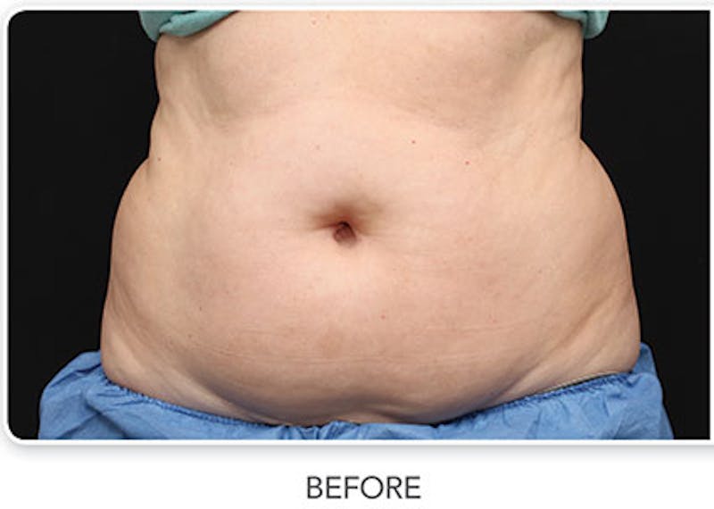CoolSculpting Before & After Gallery - Patient 100981 - Image 1