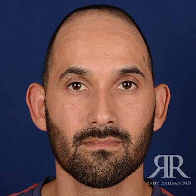 Ear Pinning Surgery Before & After Gallery - Patient 249265 - Image 1