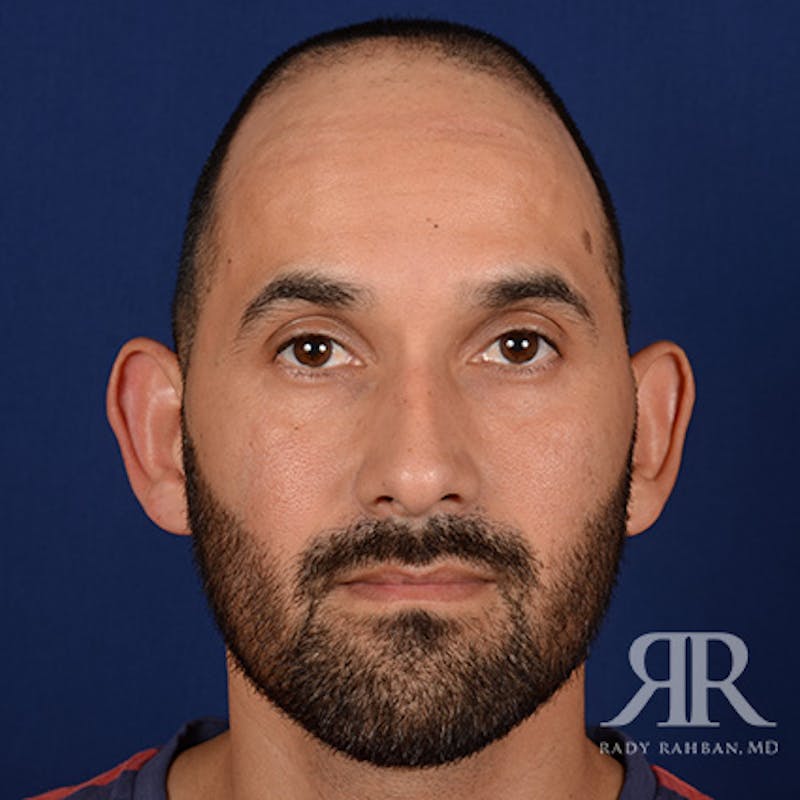 Ear Pinning Surgery Before & After Gallery - Patient 249265 - Image 1