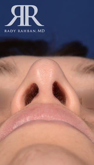 Rhinoplasty Close Up Before & After Gallery - Patient 193731 - Image 6
