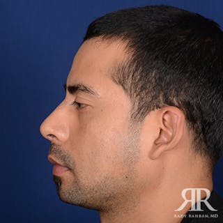 Male Rhinoplasty Before & After Gallery - Patient 205597 - Image 6