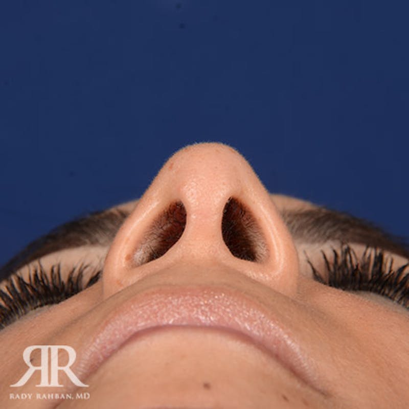 Rhinoplasty w/ Chin Implant Before & After Gallery - Patient 143598 - Image 8