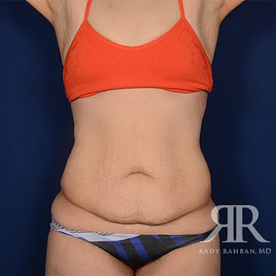 Body Lift Before & After Gallery - Patient 340927 - Image 1