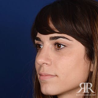 Female Rhinoplasty Before & After Gallery - Patient 122339 - Image 4
