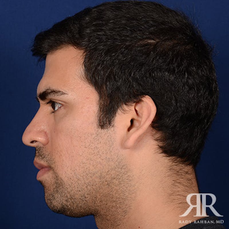 Chin Augmentation Before & After Gallery - Patient 717203 - Image 5