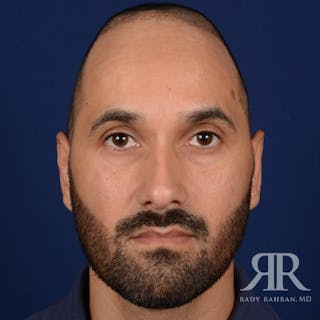 Ear Pinning Surgery Before & After Gallery - Patient 249265 - Image 2