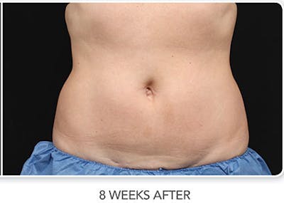 CoolSculpting Before & After Gallery - Patient 100981 - Image 2