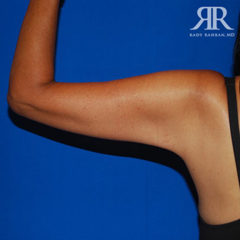 Arm Lift Before & After Gallery - Patient 661592 - Image 4