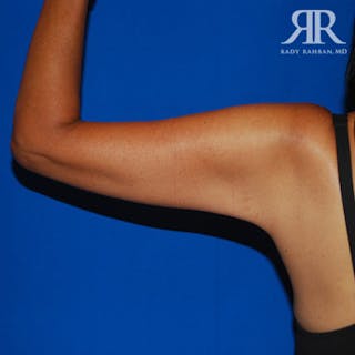 Arm Lift Before & After Gallery - Patient 661592 - Image 4