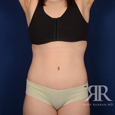 Body Lift Before & After Gallery - Patient 340927 - Image 2